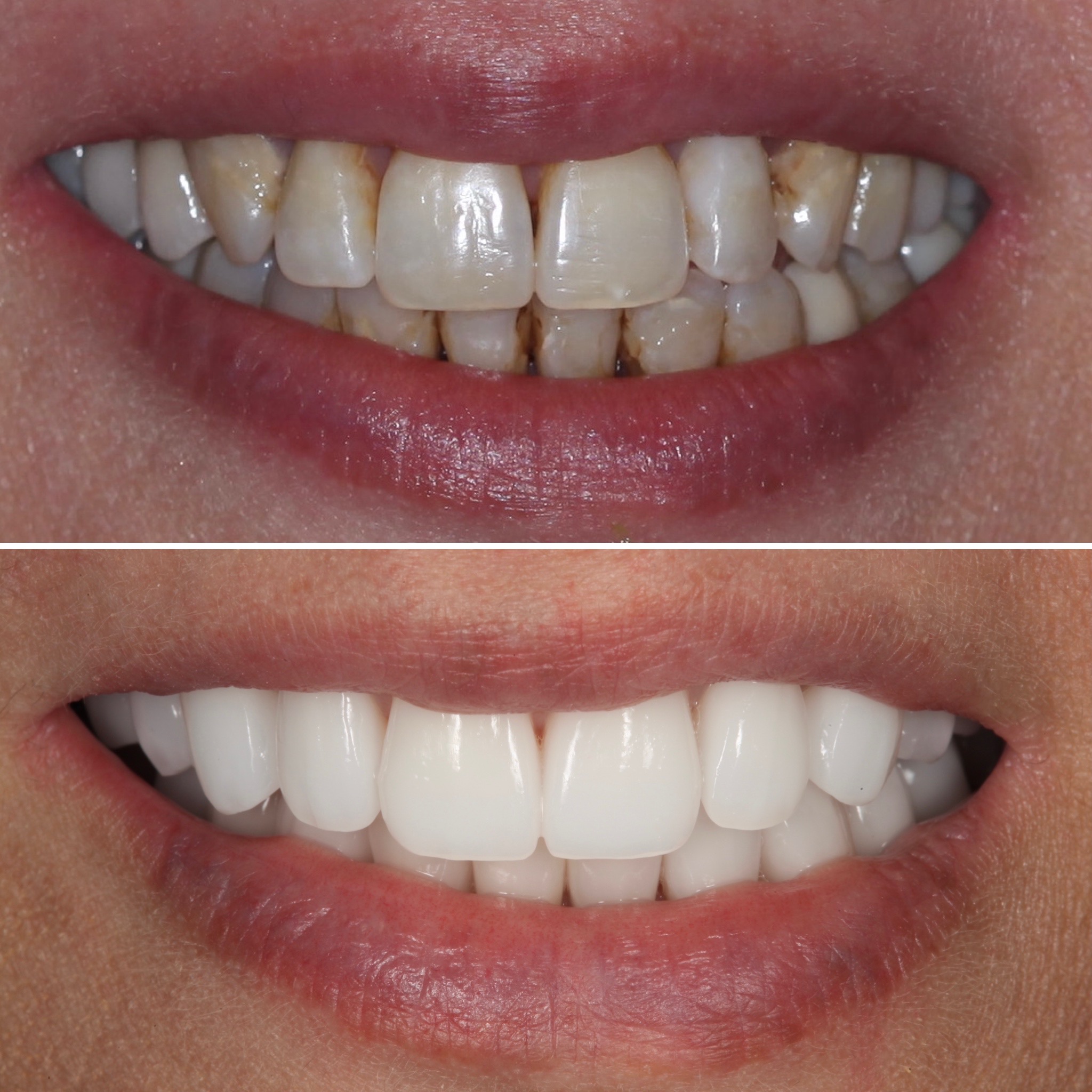 Esthetic crown restoration — Strupp & Brumm in-house master ceramist lab, Clearwater FL