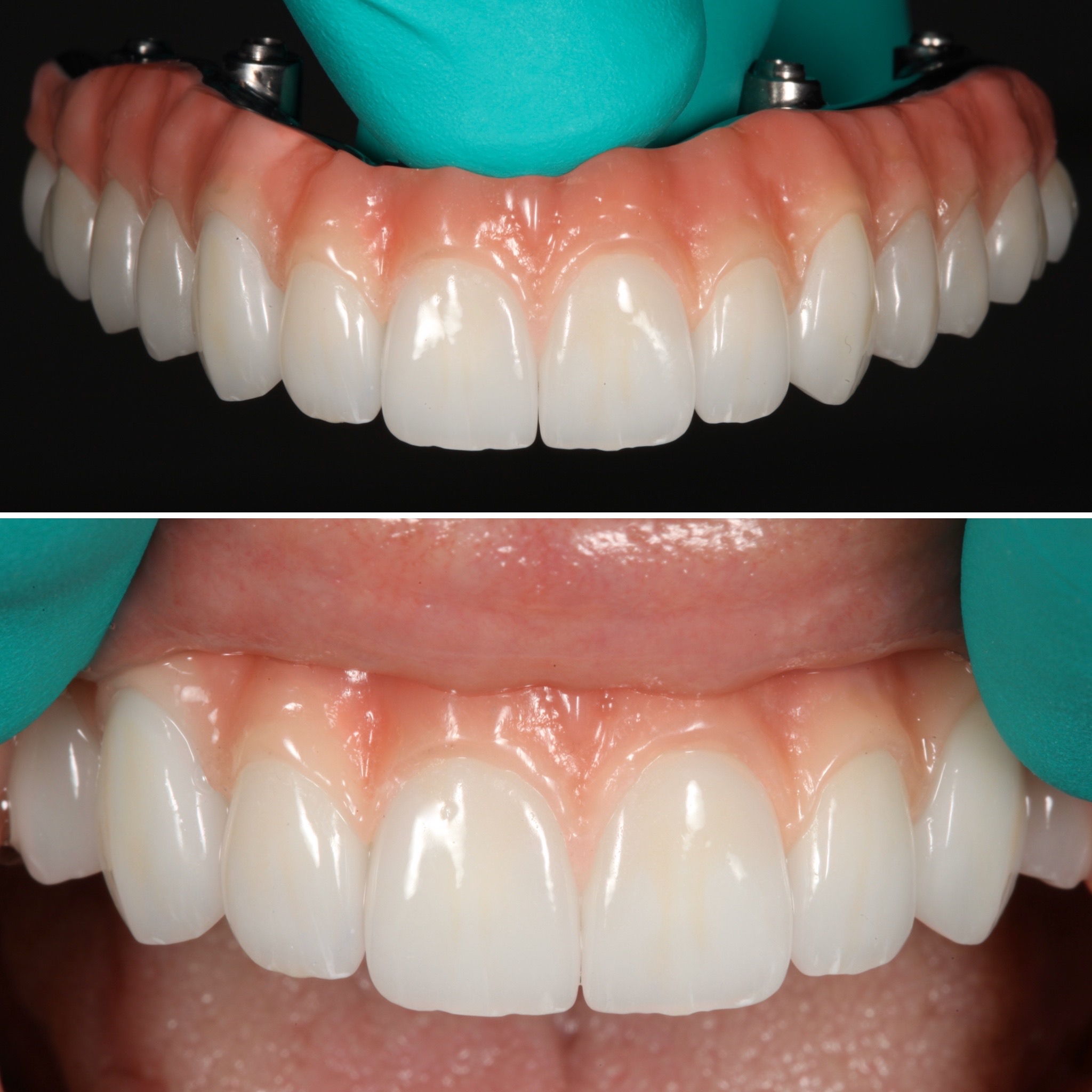 Full-arch implant hybrid by Strupp & Brumm — before and after, Clearwater, FL