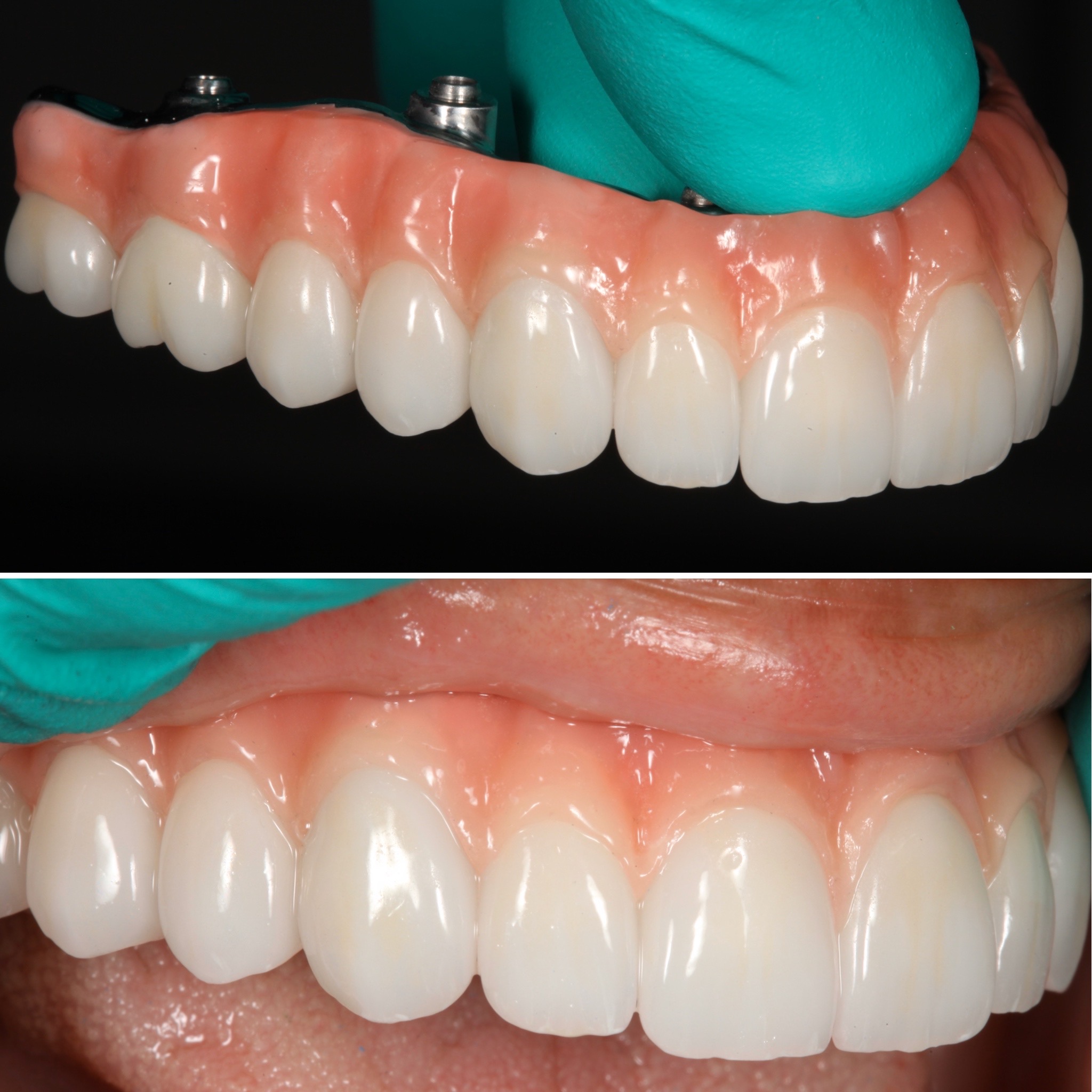 Cosmetic smile makeover — Strupp & Brumm AACD Fellows, Clearwater FL