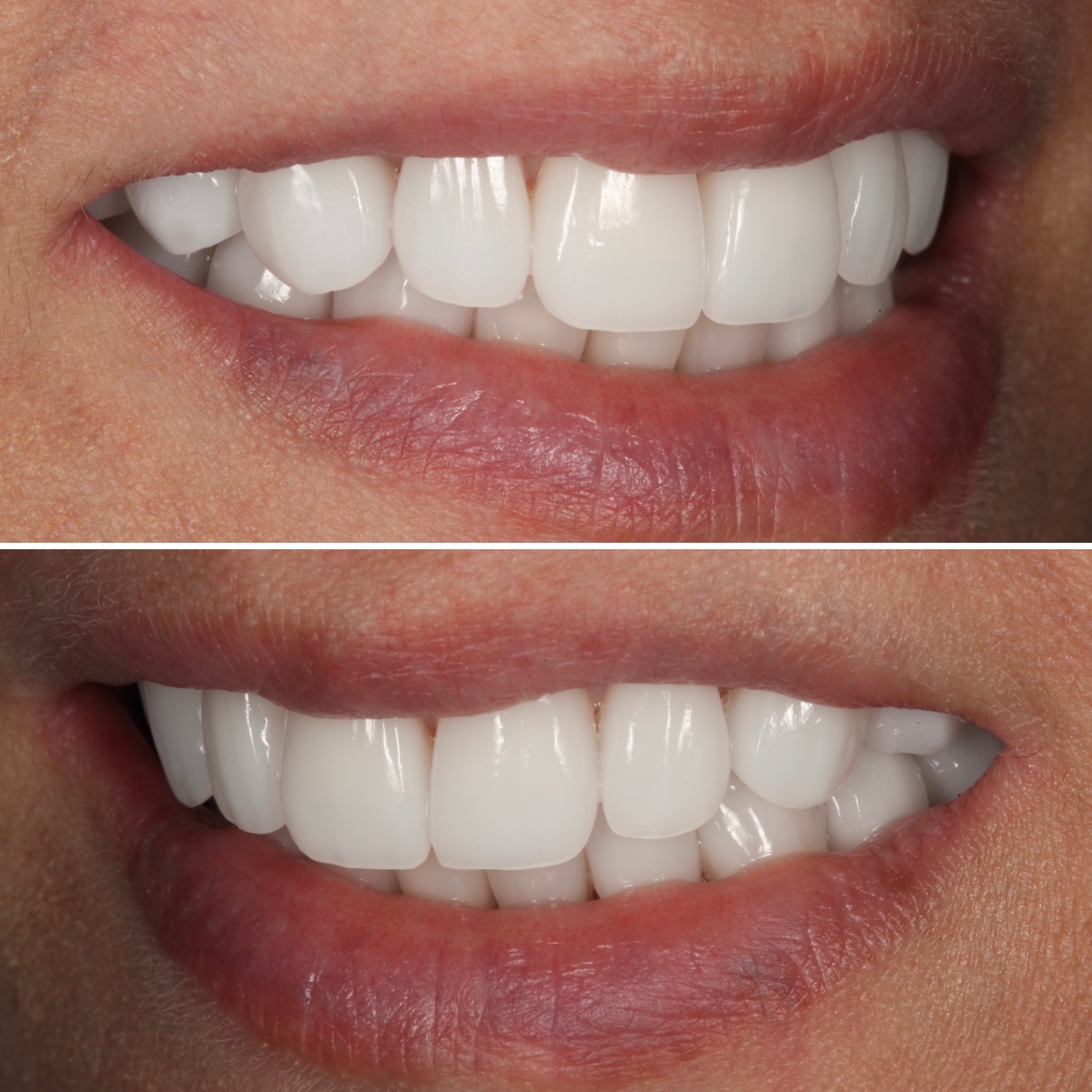 Porcelain veneers — cosmetic dentistry by Strupp & Brumm, AACD Accredited Fellows, Clearwater FL
