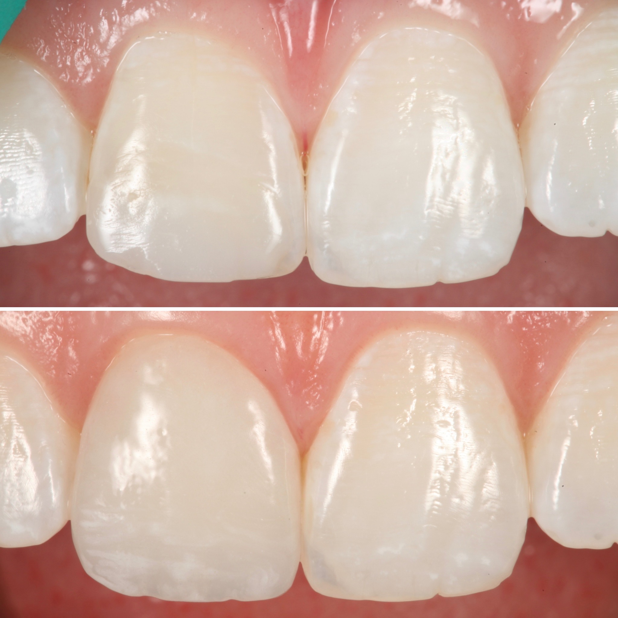 Smile design with porcelain restorations — Strupp & Brumm cosmetic dentistry, Clearwater FL