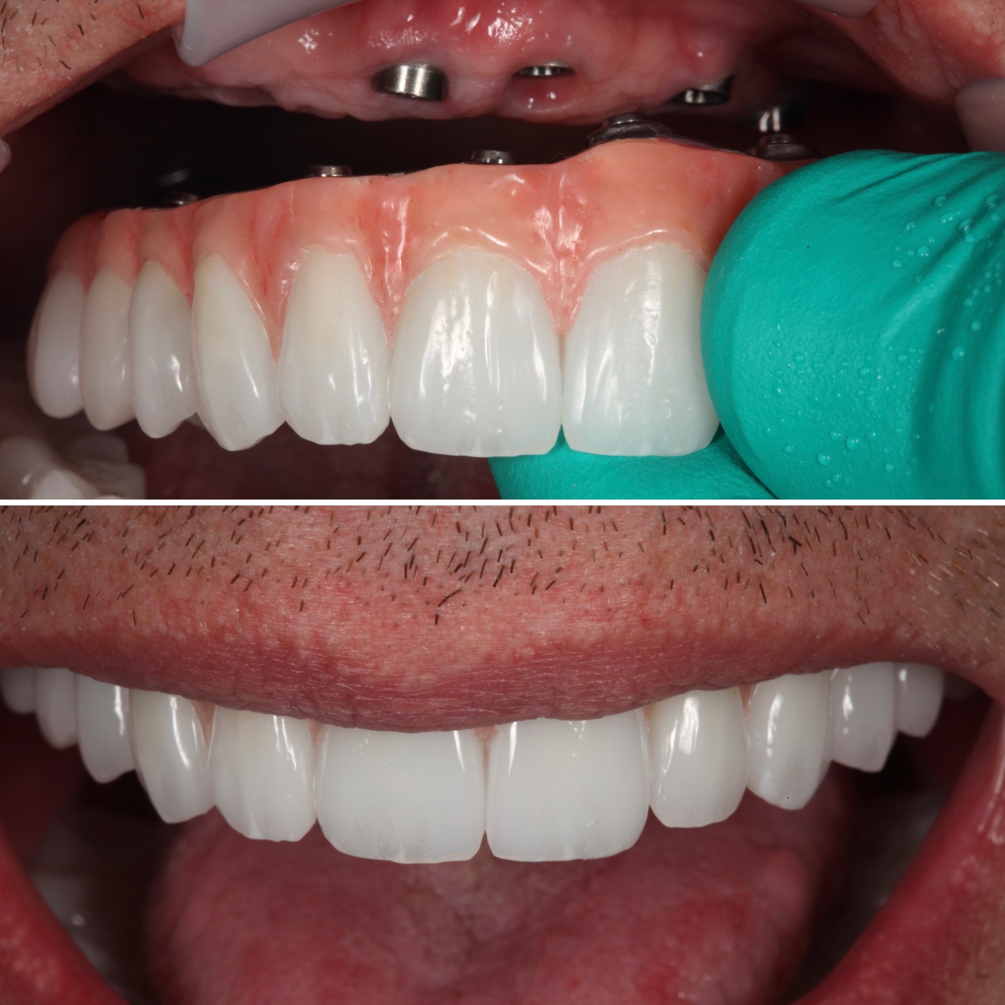 Full smile reconstruction — Strupp & Brumm AACD Accredited Fellows, Clearwater FL