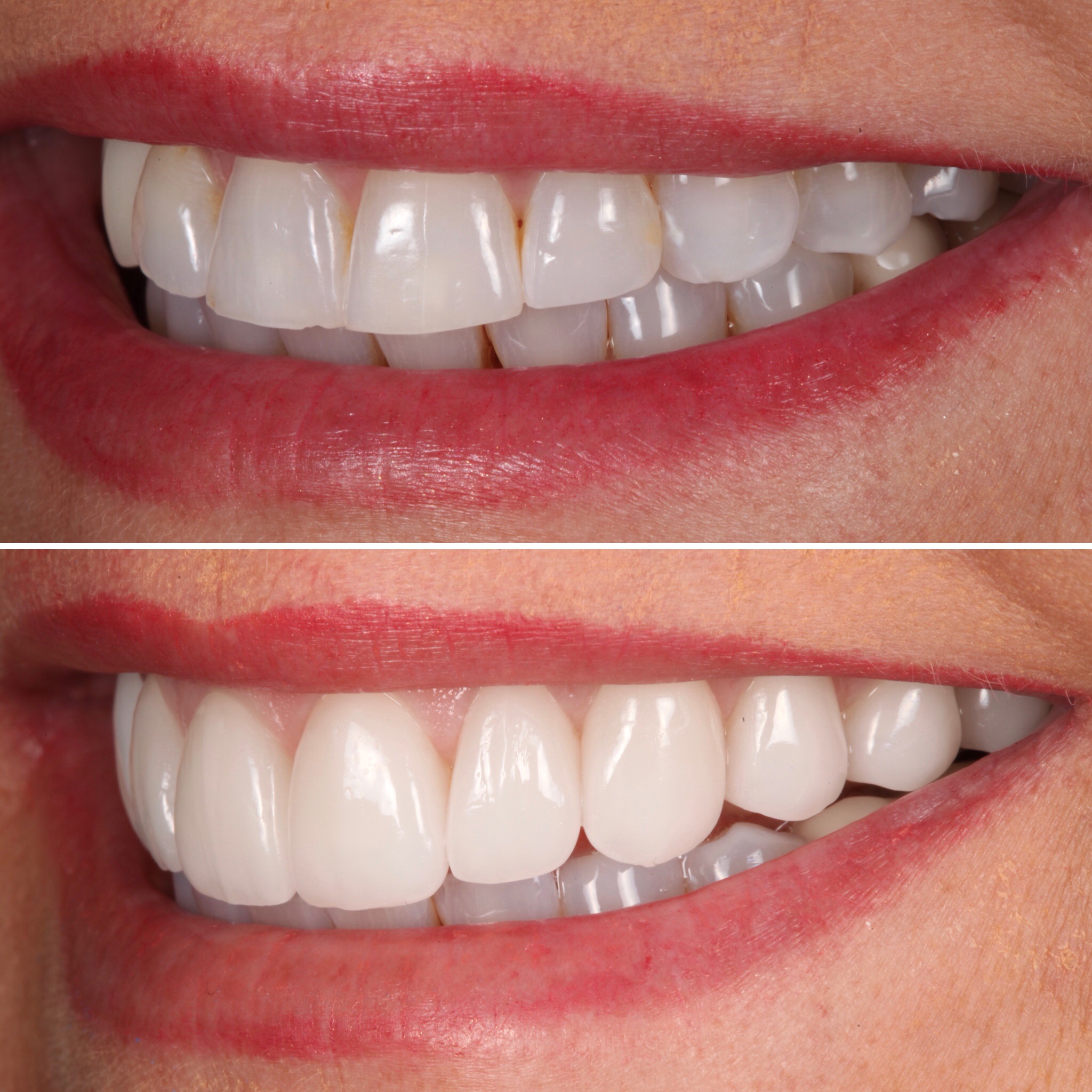 Cosmetic smile design by Strupp & Brumm — porcelain veneer result, AACD Accredited Fellows, Clearwater FL