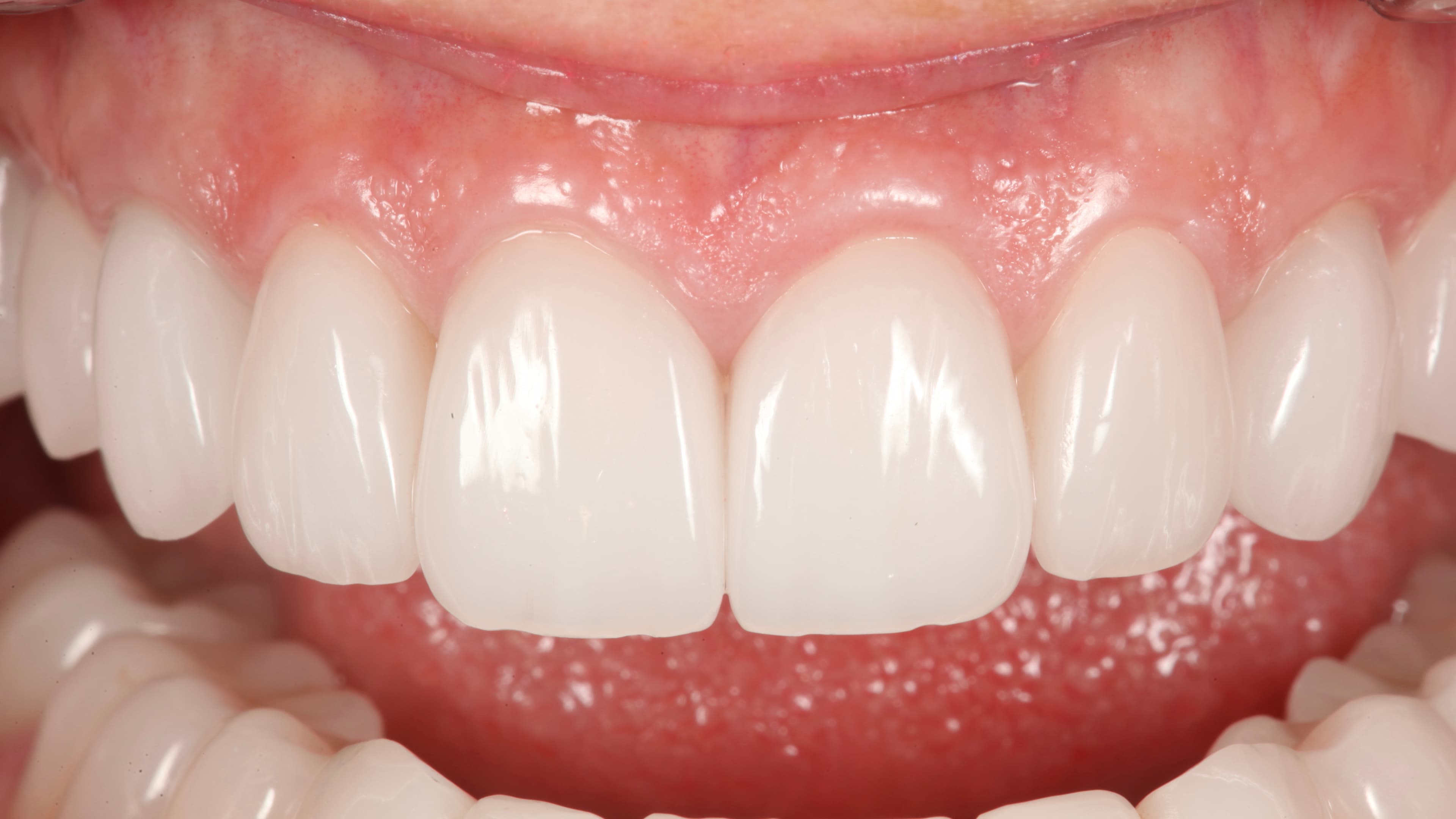 Cosmetic Dentistry at Strupp & Brumm, Clearwater FL