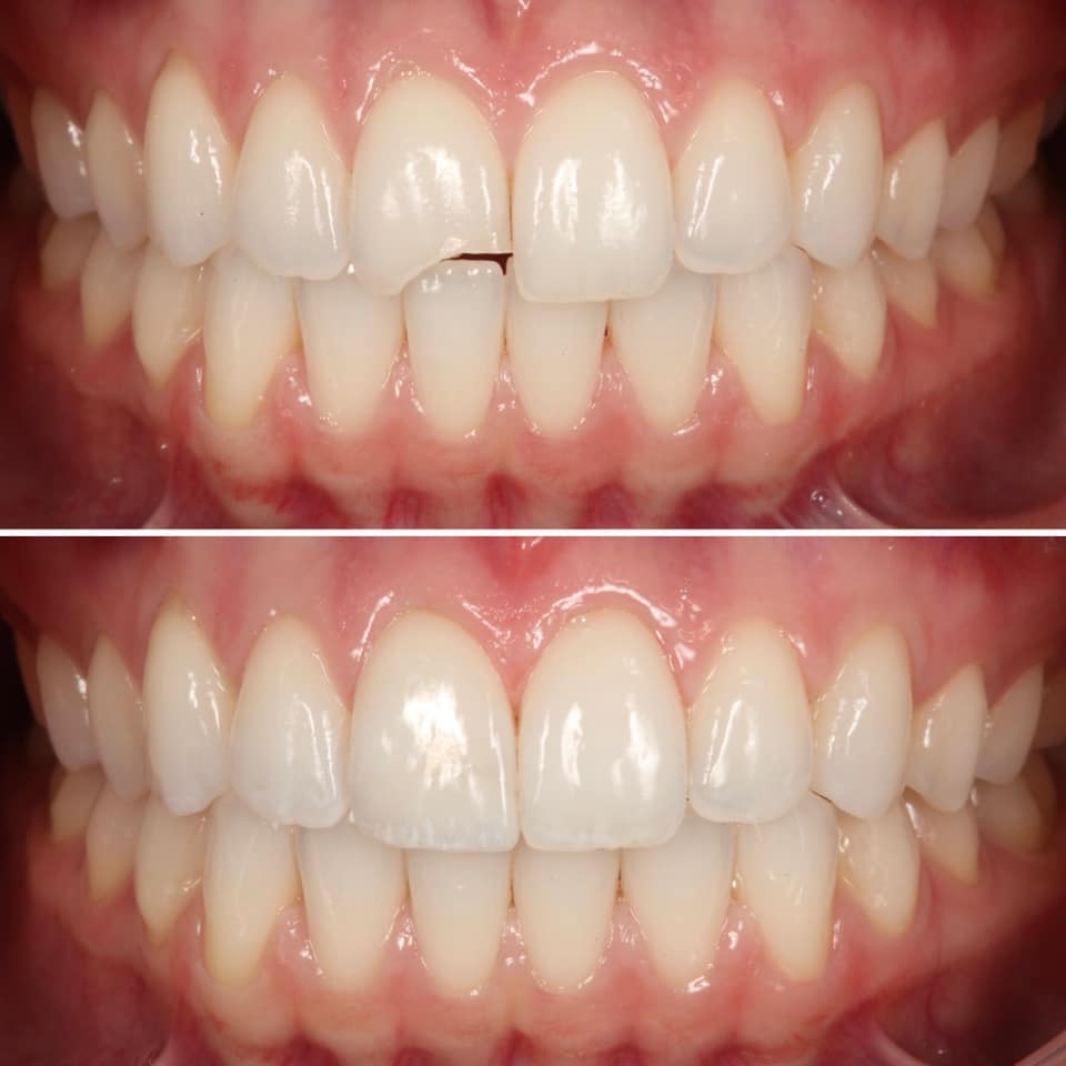 Dental Bonding at Strupp & Brumm, Clearwater FL