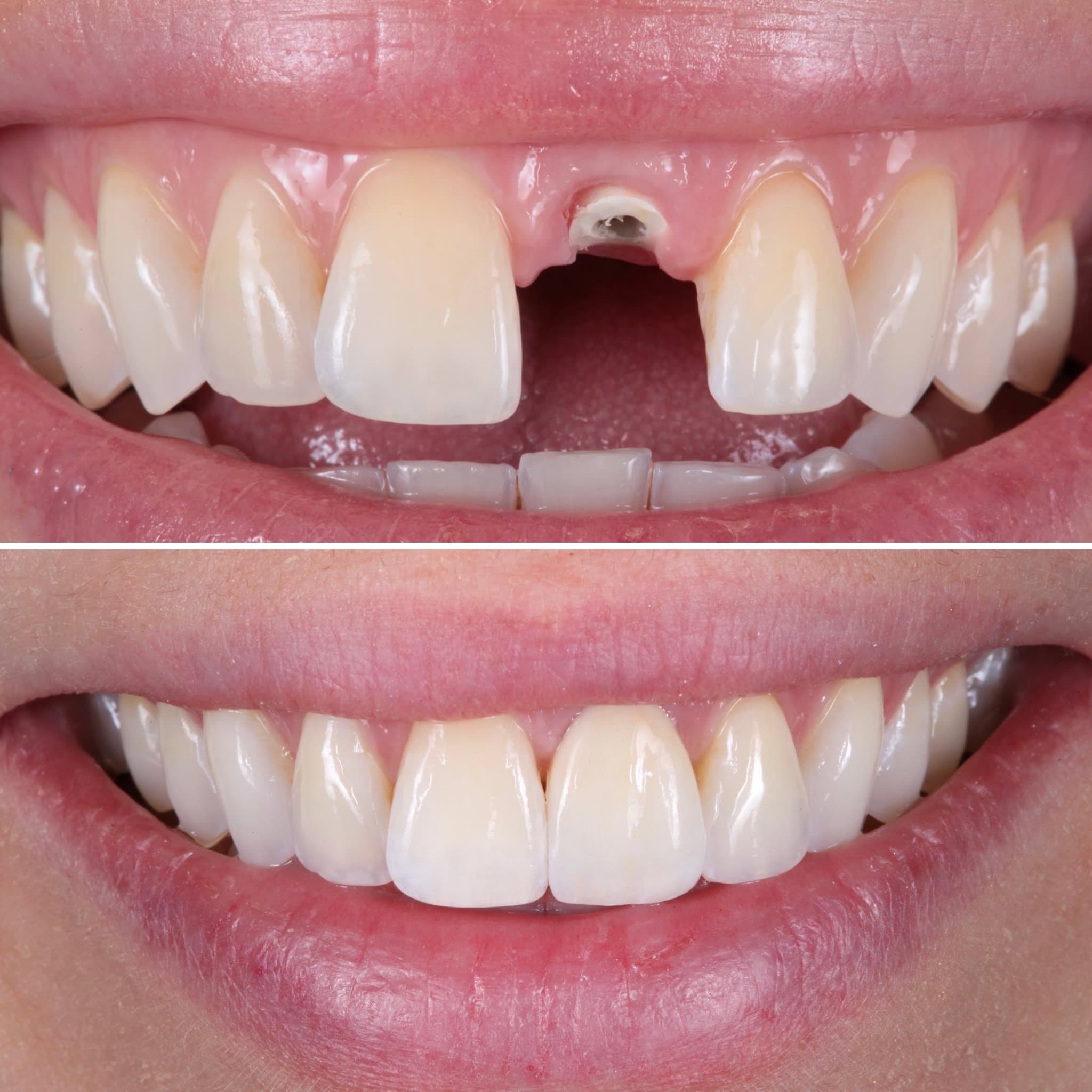 Dental Implants at Strupp & Brumm, Clearwater FL