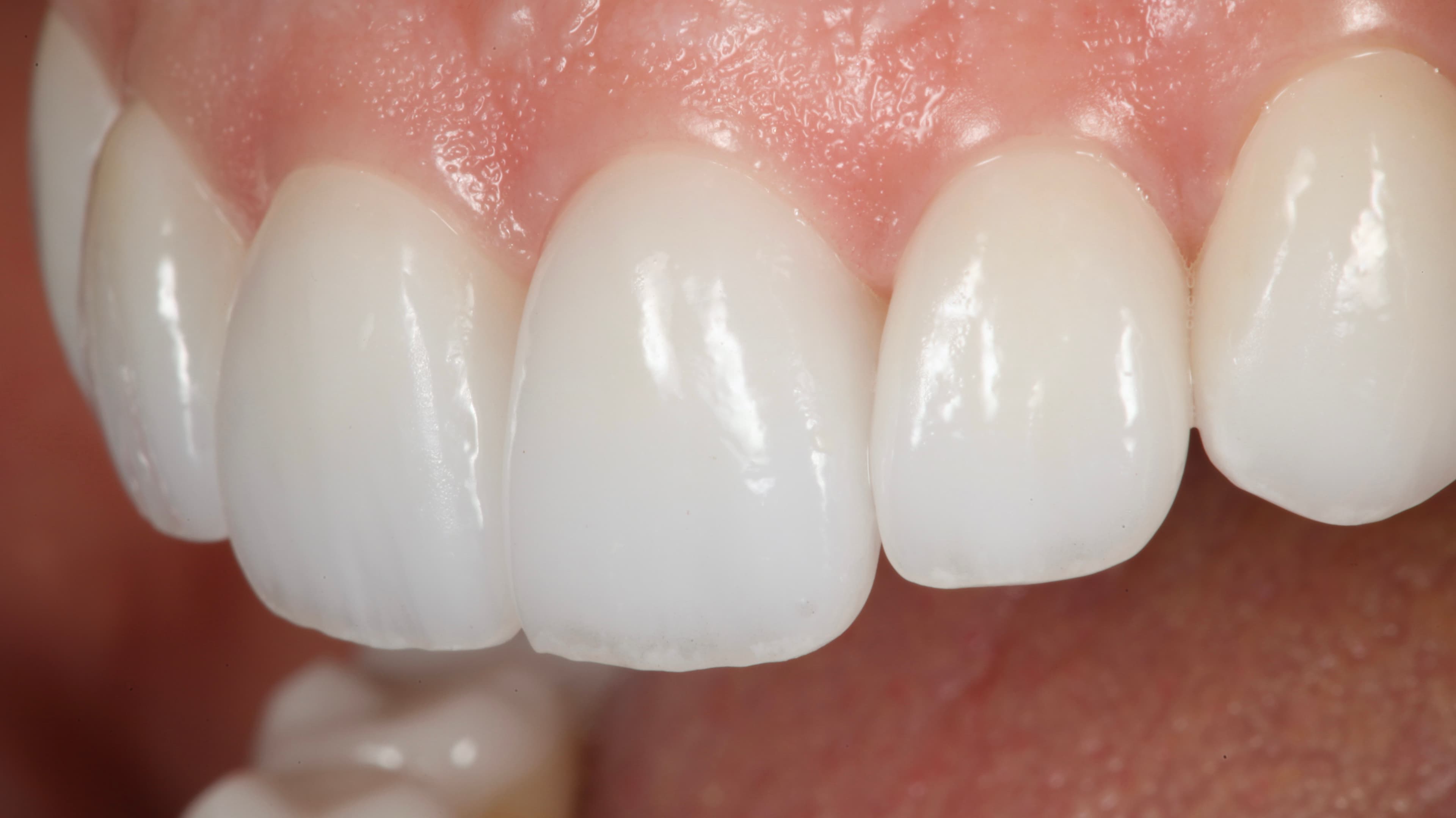Restorative Dentistry at Strupp & Brumm, Clearwater FL