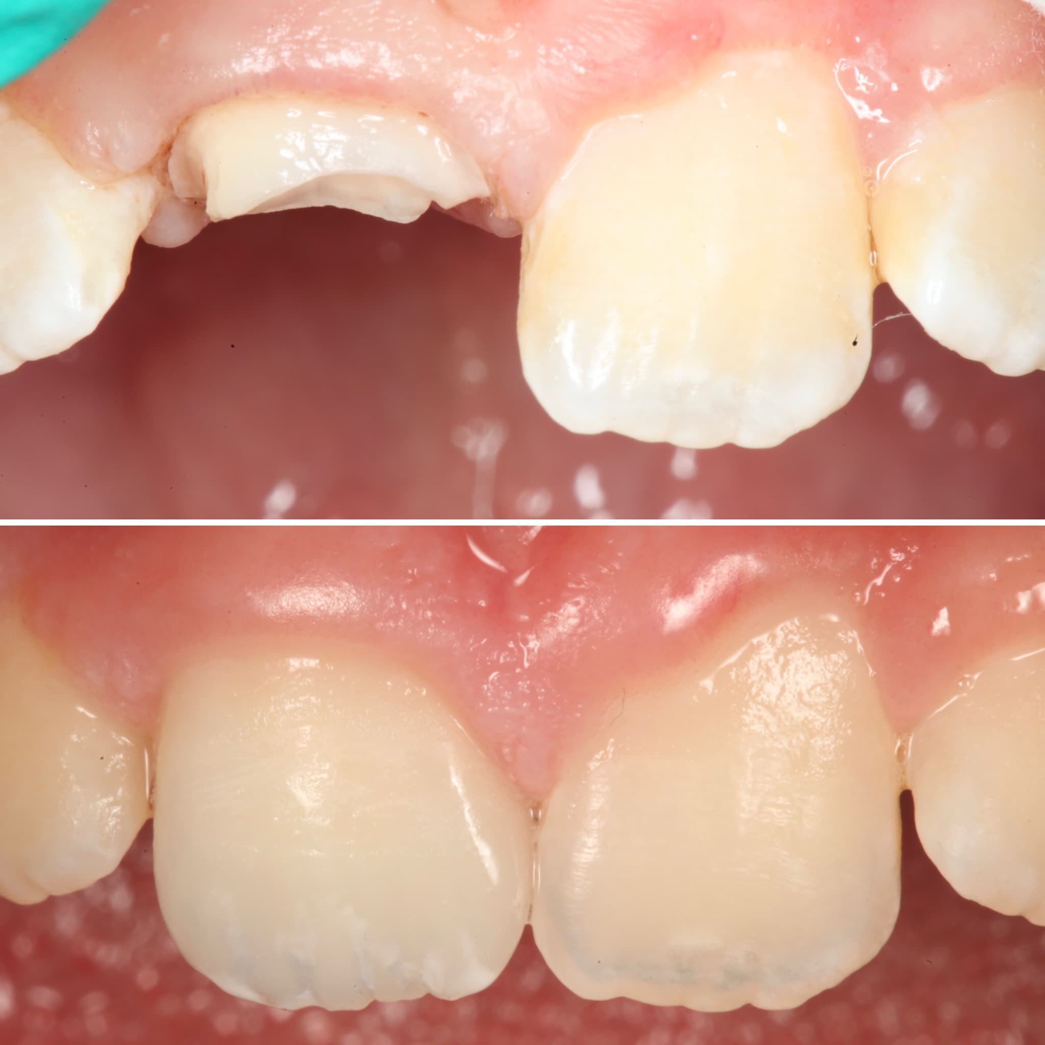 Traumatic Dental Injuries at Strupp & Brumm, Clearwater FL