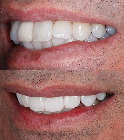 One Dental Implant and Porcelain Veneers to Replace a Failing Bridge
