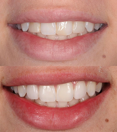 Two Porcelain Veneers and Composite Bonding