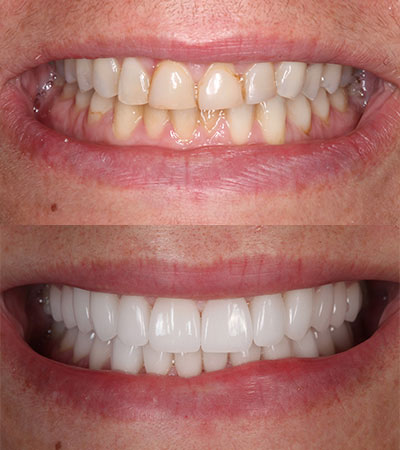 Full Mouth Porcelain Restorations