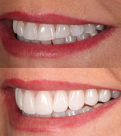 Porcelain Restorations