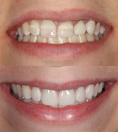 Porcelain Restorations