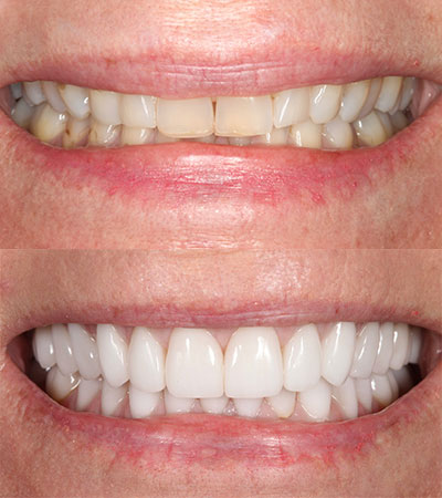 Full Mouth Porcelain Restorations