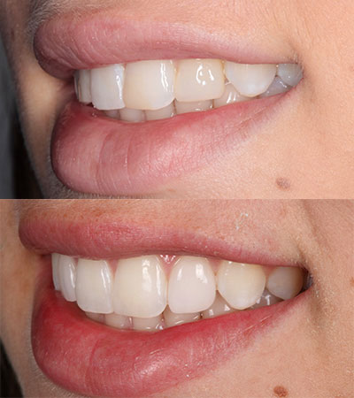 Two Porcelain Veneers and Composite Bonding