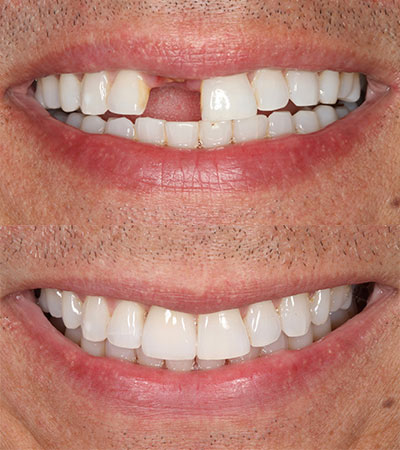Dental Implant and Porcelain Restoration