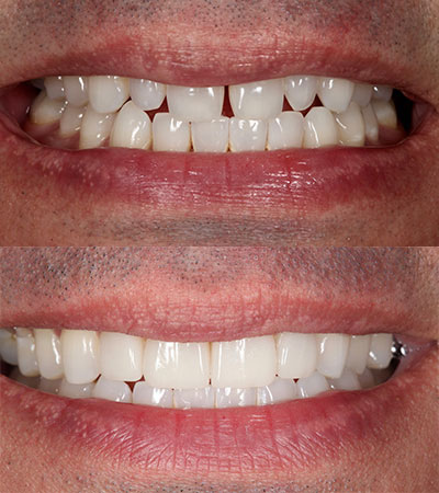 Four Porcelain Restorations