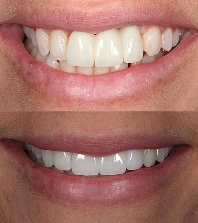 Three Dental Implants and Four Porcelain Restorations