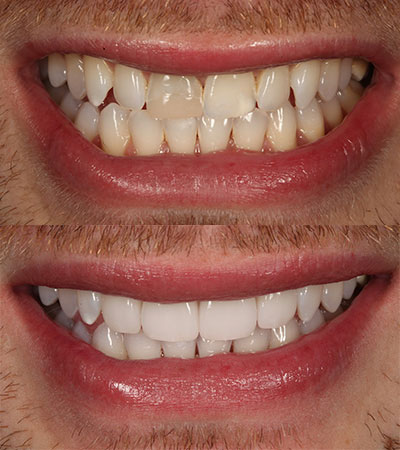 Four Porcelain Restorations