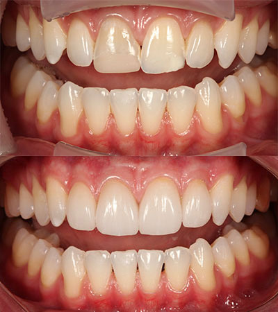 Four Porcelain Restorations