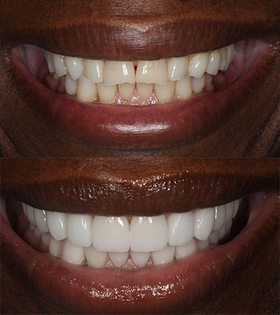 Full Mouth Porcelain Restorations