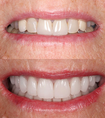 Full Mouth Porcelain Restorations