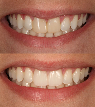 Two Porcelain Restorations Replacing Failing Composites