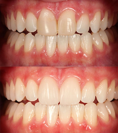 Two Porcelain Restorations Replacing Failing Composites