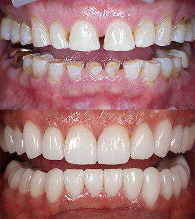 Full Mouth Porcelain Restorations