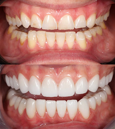 Full Mouth Porcelain Restorations