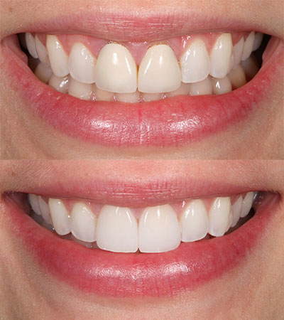 Two Porcelain Restorations