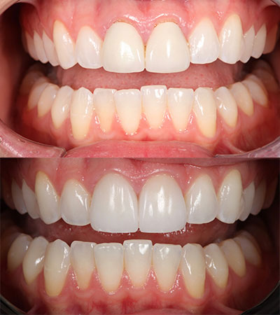 Two Porcelain Restorations