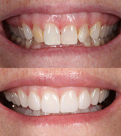 Four Porcelain Restorations