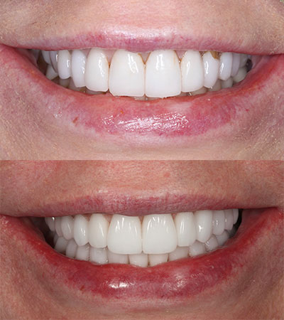 Full Mouth Porcelain Restorations