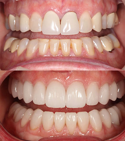 Full Mouth Porcelain Restorations