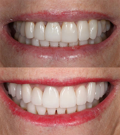 Full Mouth Porcelain Restorations