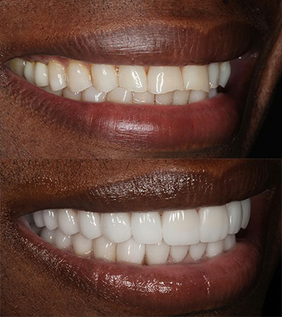 Full Mouth Porcelain Restorations