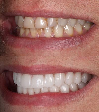 Full Mouth Porcelain Restorations