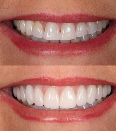 Porcelain Restorations