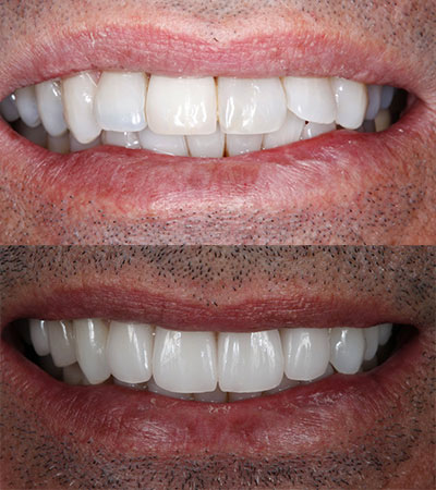 One Dental Implant and Porcelain Veneers to Replace a Failing Bridge