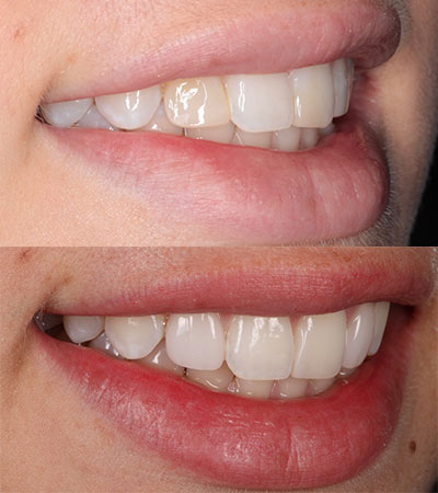 Two Porcelain Veneers and Composite Bonding