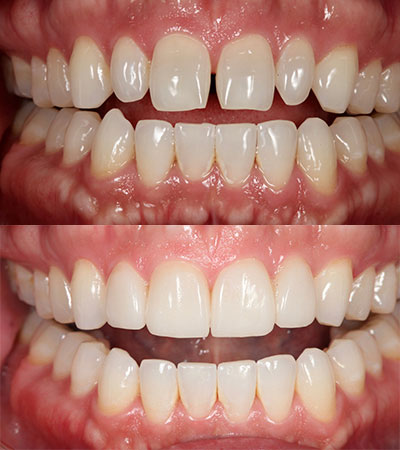 Four Porcelain Restorations