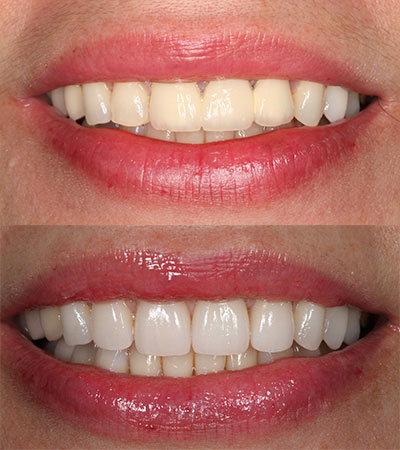 One Dental Implant and Four Porcelain Restorations