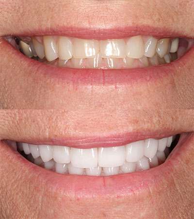 Full Mouth Porcelain Restorations