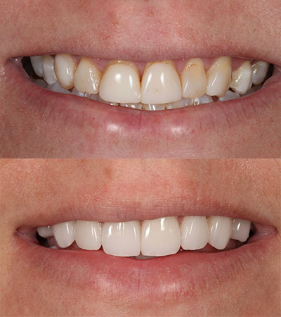 Eight Porcelain Restorations