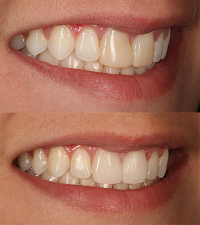 Two Porcelain Restorations Replacing Failing Composites