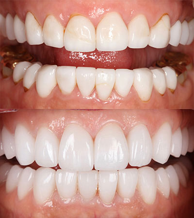 Full Mouth Porcelain Restorations