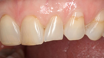 before after photo