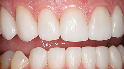 before after photo