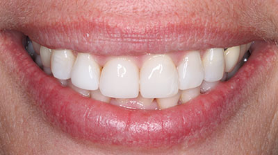 before after photo
